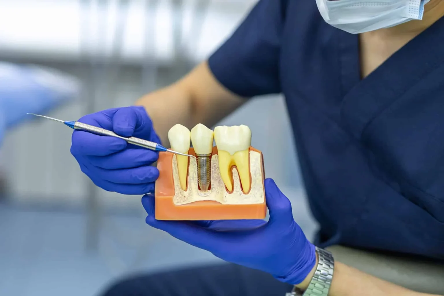 What Are Dental Implants