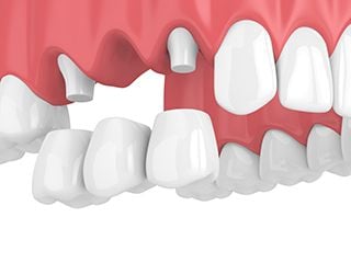 Dental bridge