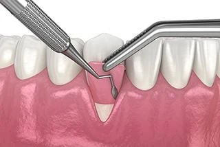Illustration of a gum graft covering a receded gumline