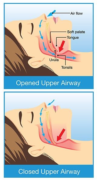 snoring and sleep apnea