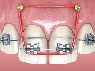 Illustration of temporary anchorage devices used with braces