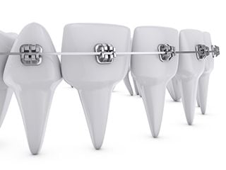 self-ligating braces